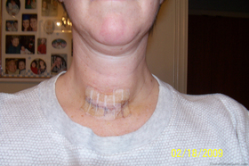 neck-picture-after-thyroid-surgery.jpg
