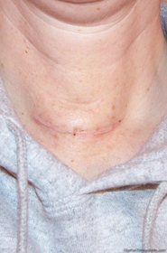 photo-of-bandage-off-after-thyroid-surgery.jpg